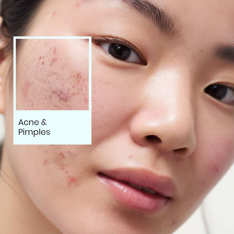 Acne & Pimples