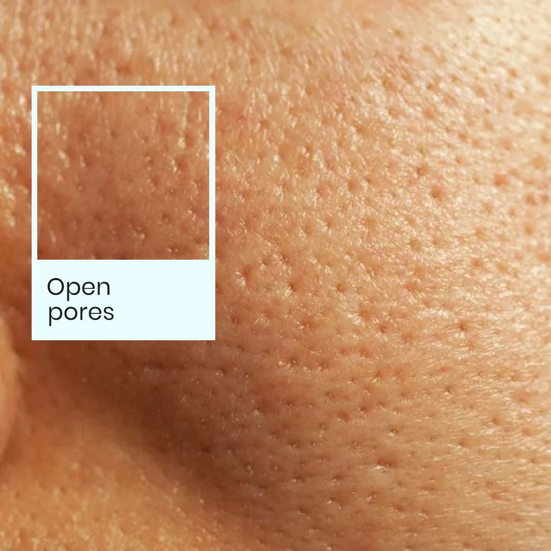 Open pores